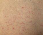 【写真】腕,脇腹,太ももに赤い斑点・湿疹が大量発生！原因は布団ダニ？
